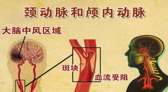 頸部動脈粥樣硬化產(chǎn)生的原因及治療預(yù)防新措施