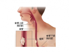 食管癌術(shù)后護(hù)理的新管理技術(shù)